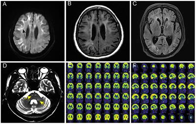 The Value of NOTCH2NLC Gene Detection and Skin Biopsy in the Diagnosis of Neuronal Intranuclear Inclusion Disease